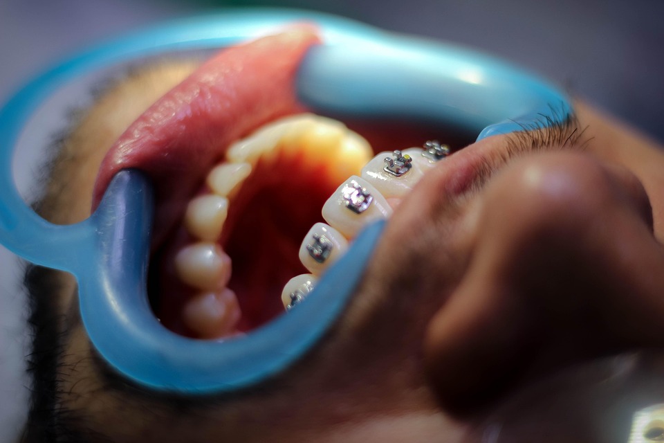 Veneers Last